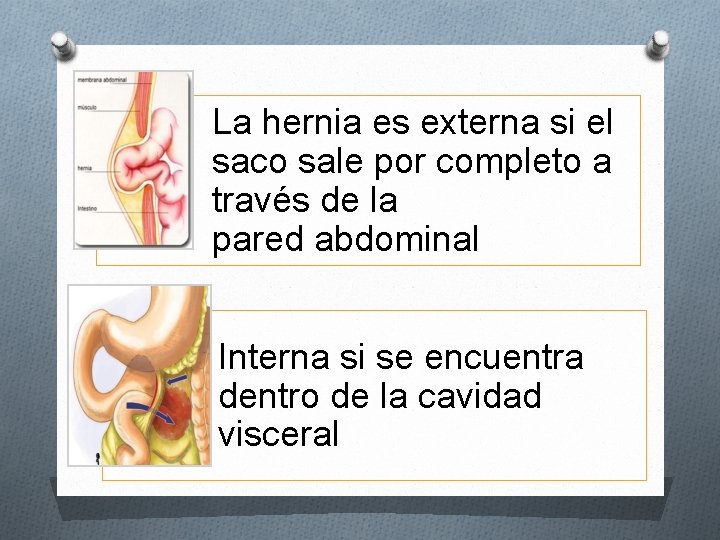 La hernia es externa si el saco sale por completo a través de la