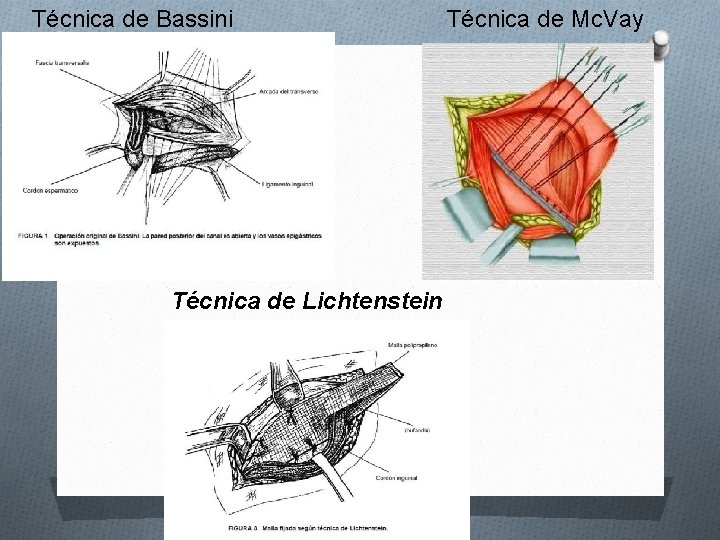 Técnica de Bassini Técnica de Lichtenstein Técnica de Mc. Vay 