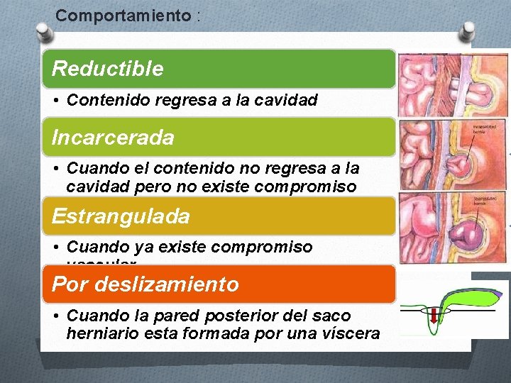 Comportamiento : Reductible • Contenido regresa a la cavidad Incarcerada • Cuando el contenido