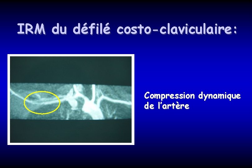 IRM du défilé costo-claviculaire: Compression dynamique de l’artère 