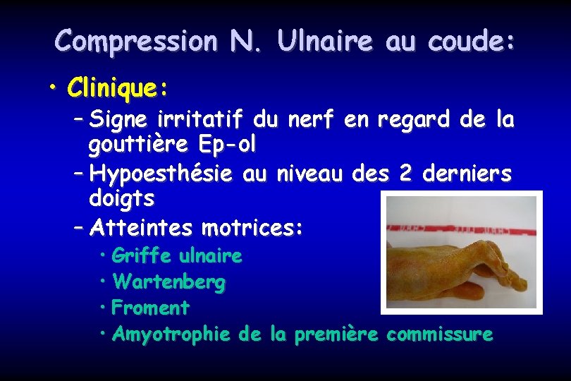 Compression N. Ulnaire au coude: • Clinique: – Signe irritatif du nerf en regard