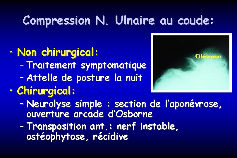 Compression N. Ulnaire au coude: • Non chirurgical: – Traitement symptomatique – Attelle de