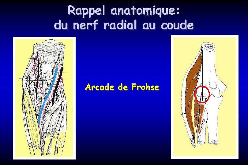 Rappel anatomique: du nerf radial au coude Arcade de Frohse 