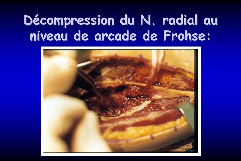 Décompression du N. niveau de arcade de radial au Frohse: 