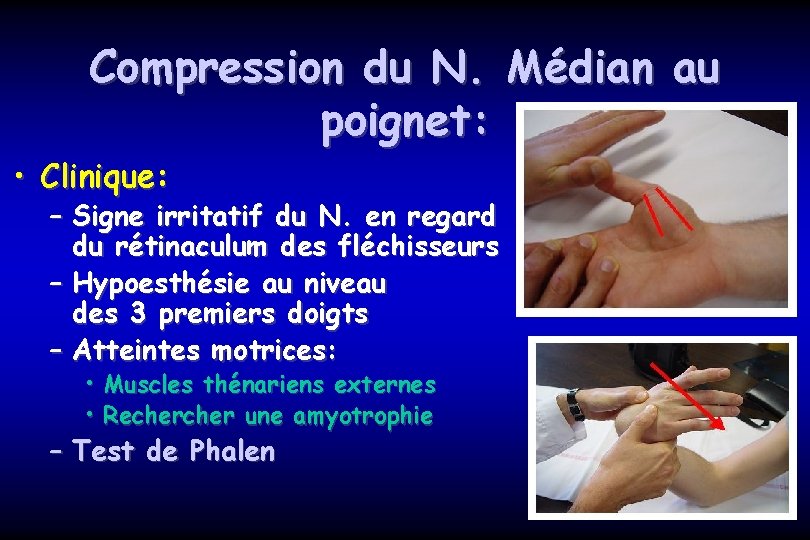 Compression du N. Médian au poignet: • Clinique: – Signe irritatif du N. en