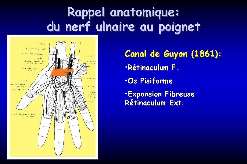 Rappel anatomique: du nerf ulnaire au poignet Canal de Guyon (1861): • Rétinaculum F.