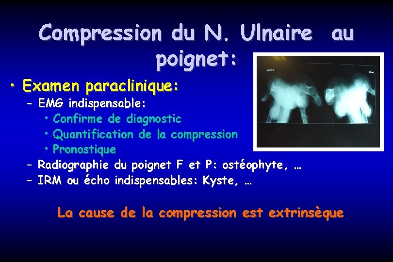 Compression du N. Ulnaire au poignet: • Examen paraclinique: – EMG indispensable: • Confirme
