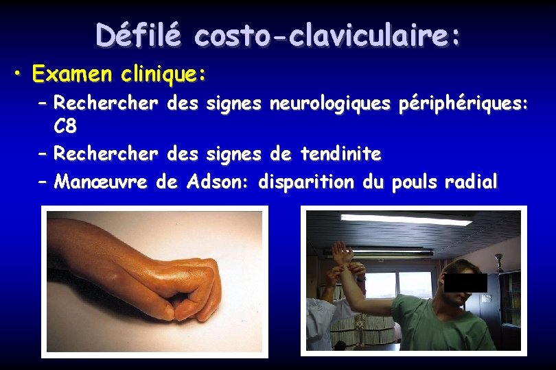 Défilé costo-claviculaire: • Examen clinique: – Recher des signes neurologiques périphériques: C 8 –