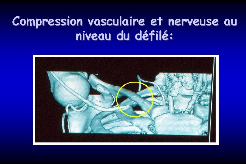 Compression vasculaire et nerveuse au niveau du défilé: 