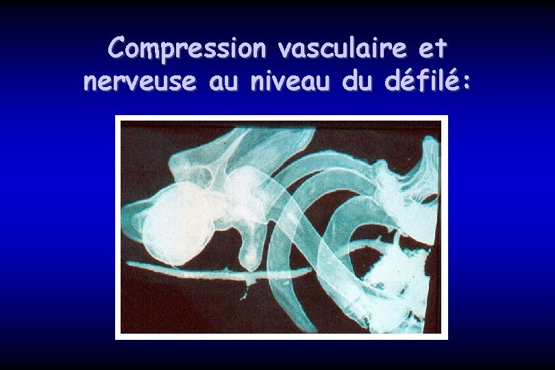 Compression vasculaire et nerveuse au niveau du défilé: 