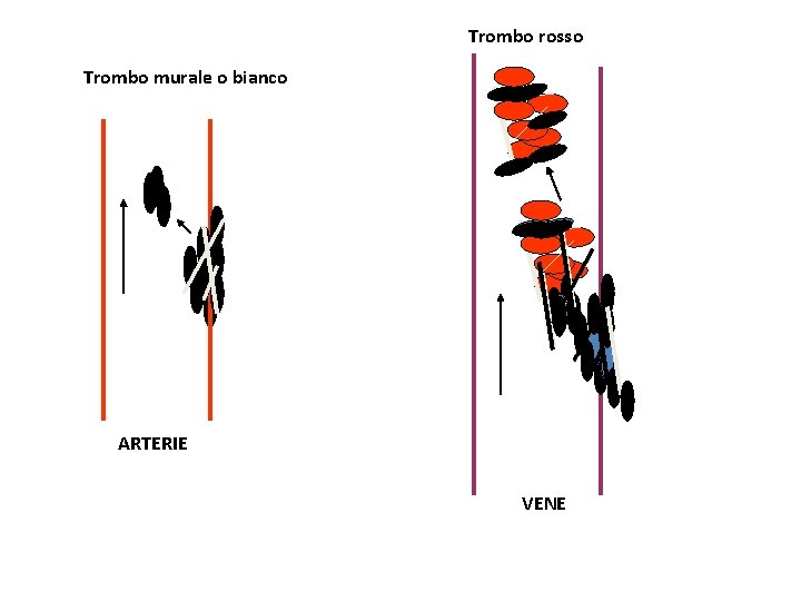 Trombo rosso Trombo murale o bianco ARTERIE VENE 