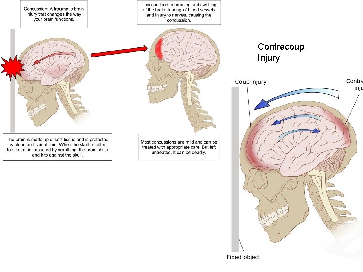Contrecoup Injury 