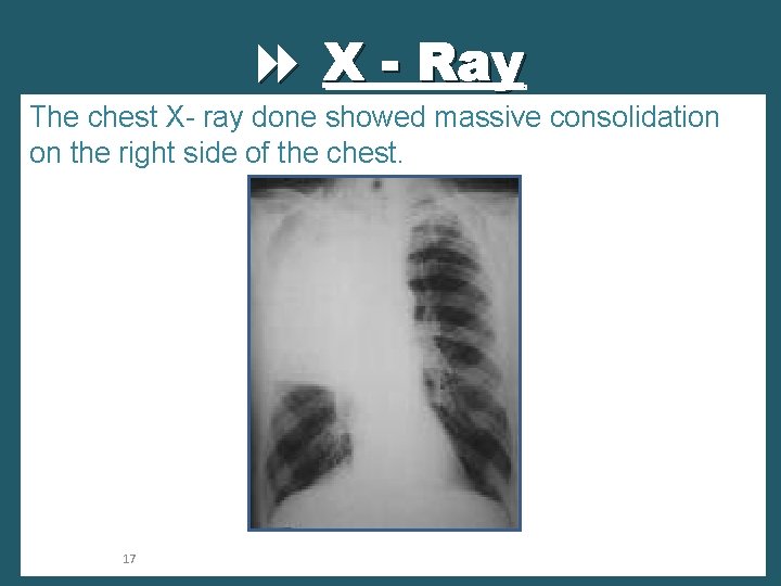  X - Ray The chest X- ray done showed massive consolidation on the