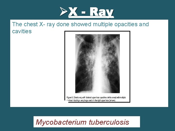 ØX - Ray The chest X- ray done showed multiple opacities and cavities Mycobacterium