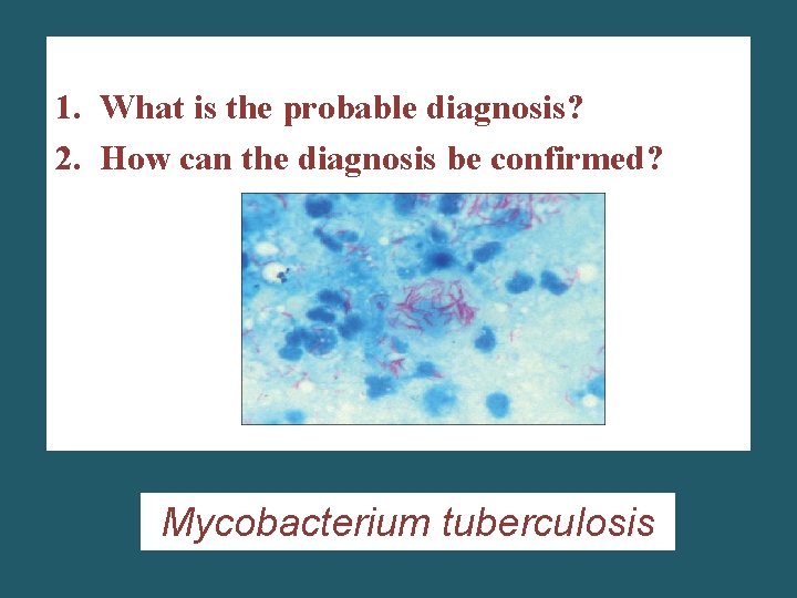 1. What is the probable diagnosis? 2. How can the diagnosis be confirmed? Mycobacterium