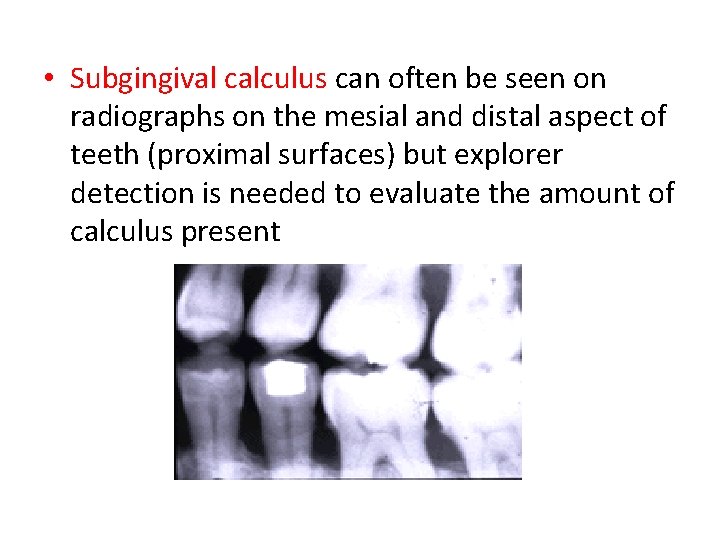  • Subgingival calculus can often be seen on radiographs on the mesial and