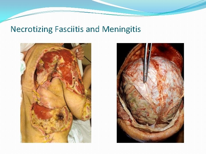 Necrotizing Fasciitis and Meningitis 