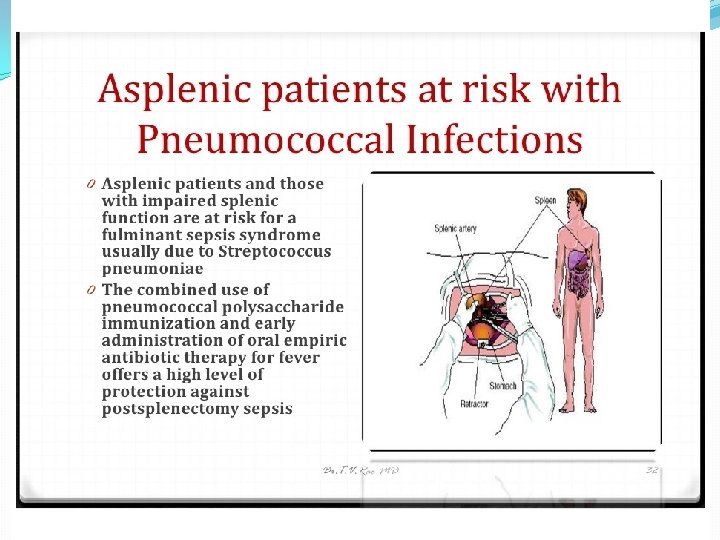 Strep pneumoniae �Epidemiology � Mouth � Upper respiratory � Dz = lungs �Pathogenicity �