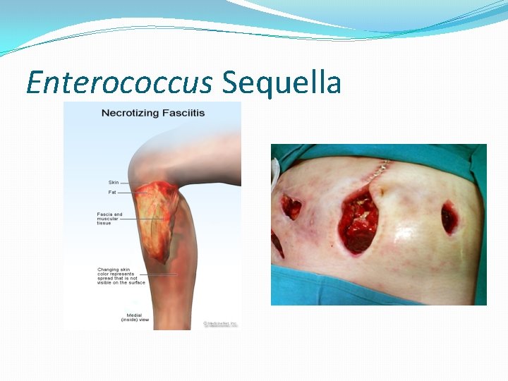 Enterococcus Sequella 