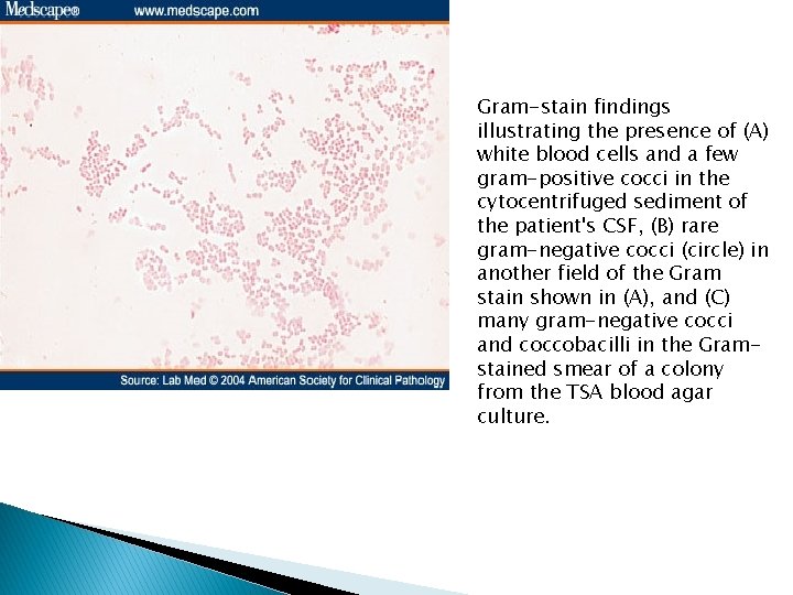 Gram-stain findings illustrating the presence of (A) white blood cells and a few gram-positive