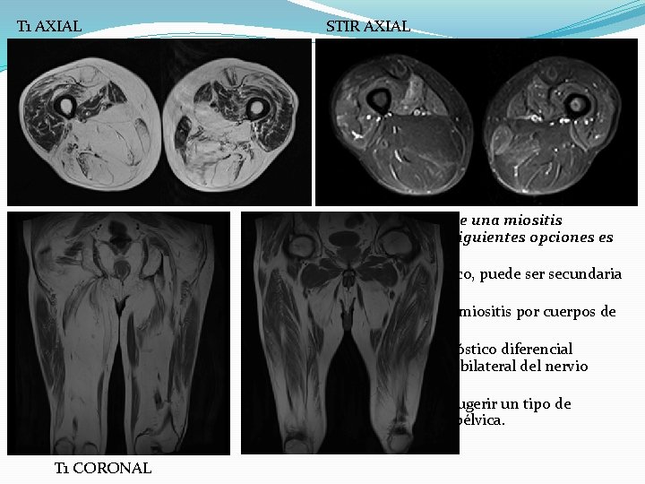 T 1 AXIAL STIR AXIAL ● Considerando que se trata de una miositis evolucionada.