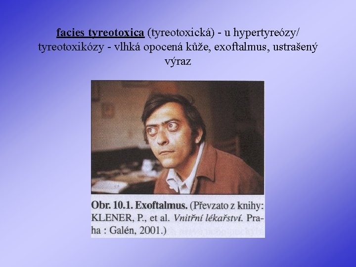 facies tyreotoxica (tyreotoxická) - u hypertyreózy/ tyreotoxikózy - vlhká opocená kůže, exoftalmus, ustrašený výraz