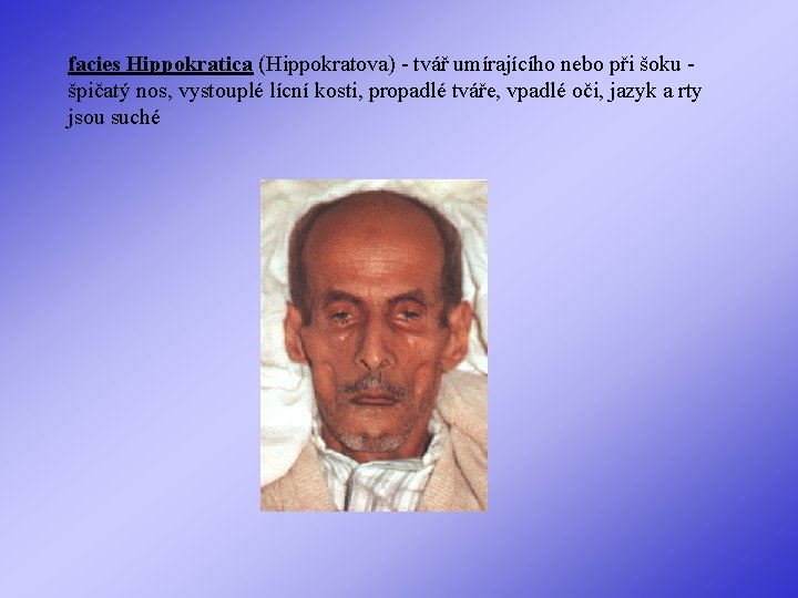 facies Hippokratica (Hippokratova) - tvář umírajícího nebo při šoku špičatý nos, vystouplé lícní kosti,