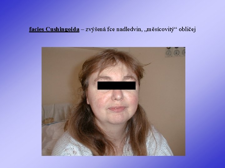 facies Cushingoida – zvýšená fce nadledvin, „měsícovitý“ obličej 