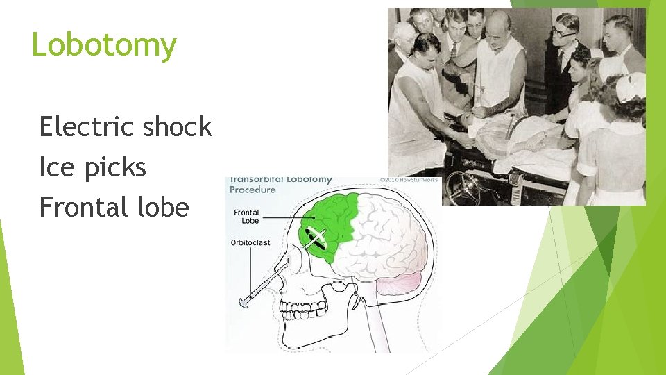 Lobotomy Electric shock Ice picks Frontal lobe 