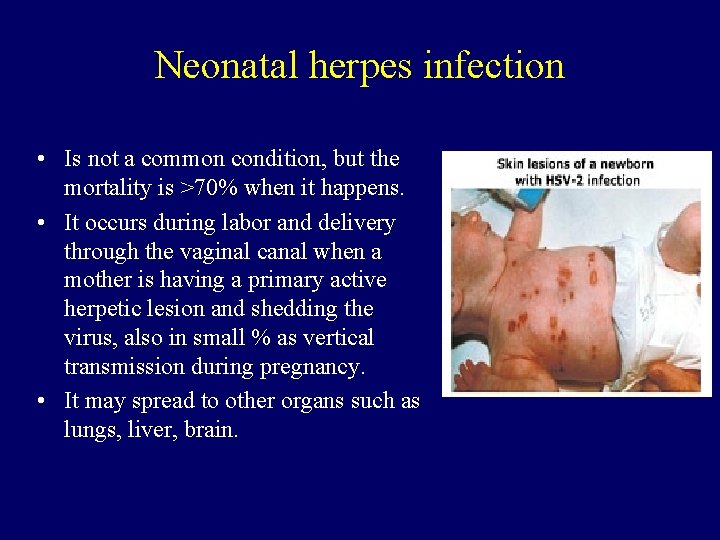 Neonatal herpes infection • Is not a common condition, but the mortality is >70%