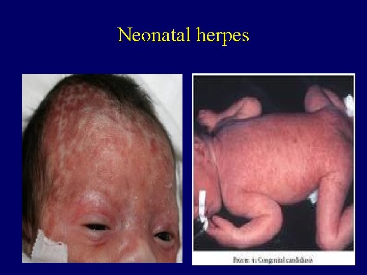 Neonatal herpes 