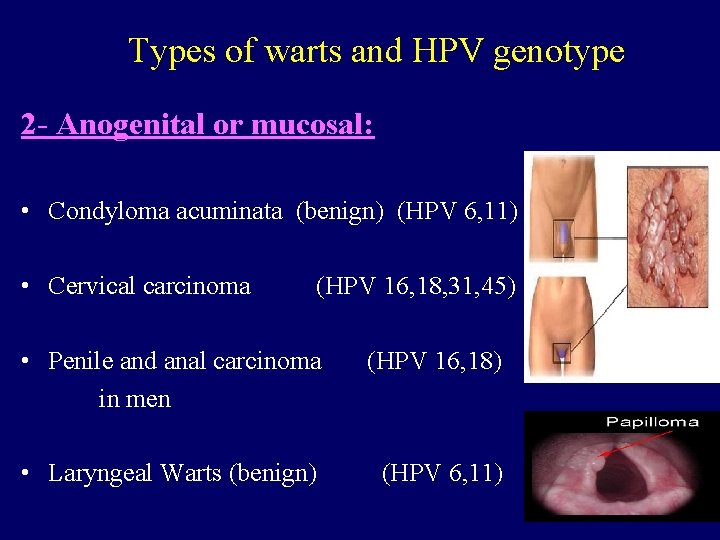 Types of warts and HPV genotype 2 - Anogenital or mucosal: • Condyloma acuminata