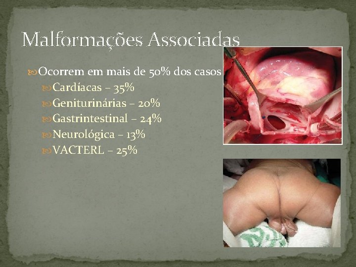 Malformações Associadas Ocorrem em mais de 50% dos casos Cardíacas – 35% Geniturinárias –