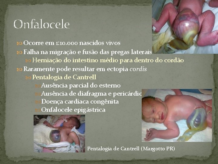 Onfalocele Ocorre em 1: 10. 000 nascidos vivos Falha na migração e fusão das