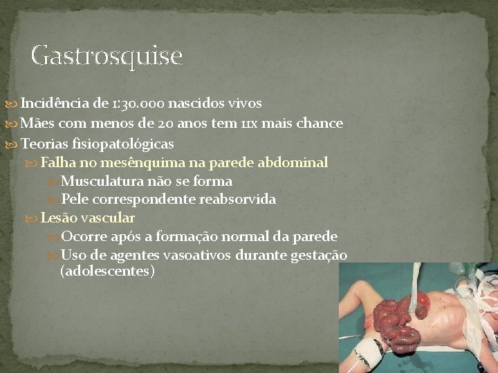 Gastrosquise Incidência de 1: 30. 000 nascidos vivos Mães com menos de 20 anos