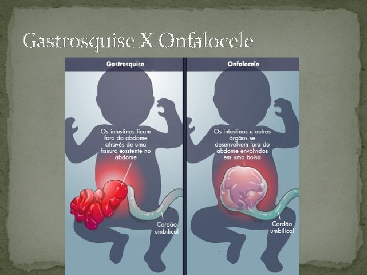 Gastrosquise X Onfalocele 