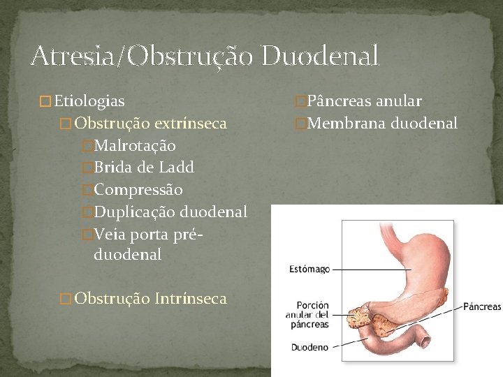 Atresia/Obstrução Duodenal � Etiologias � Obstrução extrínseca �Malrotação �Brida de Ladd �Compressão �Duplicação duodenal