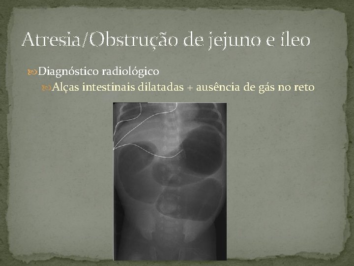 Atresia/Obstrução de jejuno e íleo Diagnóstico radiológico Alças intestinais dilatadas + ausência de gás