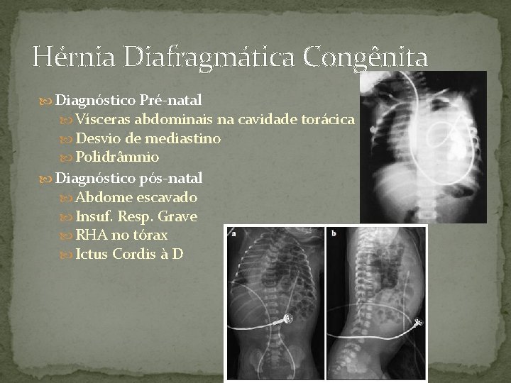 Hérnia Diafragmática Congênita Diagnóstico Pré-natal Vísceras abdominais na cavidade torácica Desvio de mediastino Polidrâmnio