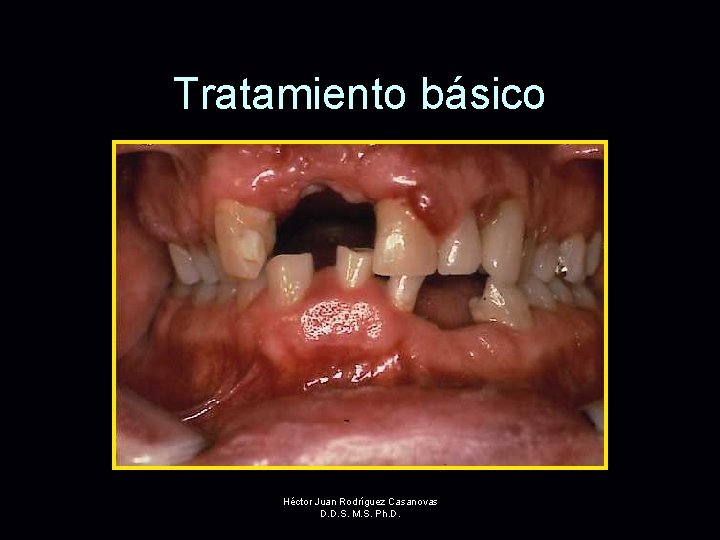 Tratamiento básico Héctor Juan Rodríguez Casanovas D. D. S. M. S. Ph. D. 