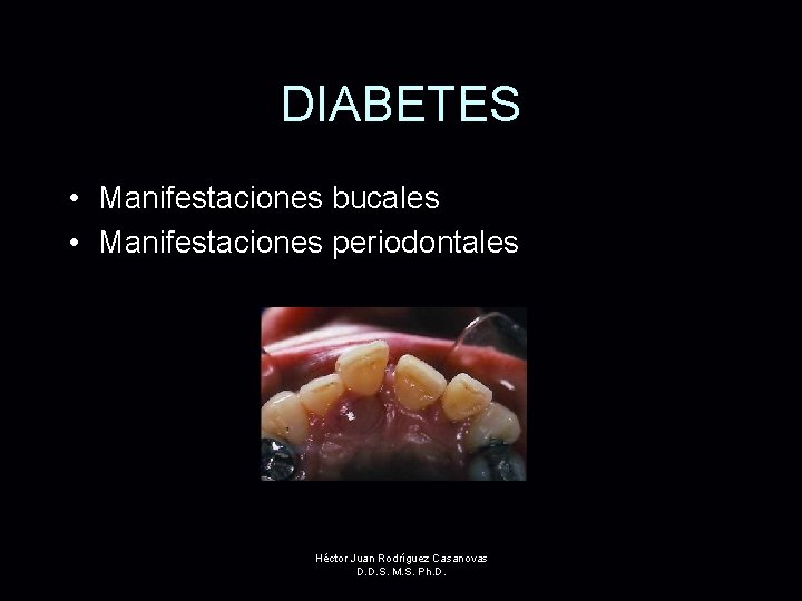 DIABETES • Manifestaciones bucales • Manifestaciones periodontales Héctor Juan Rodríguez Casanovas D. D. S.