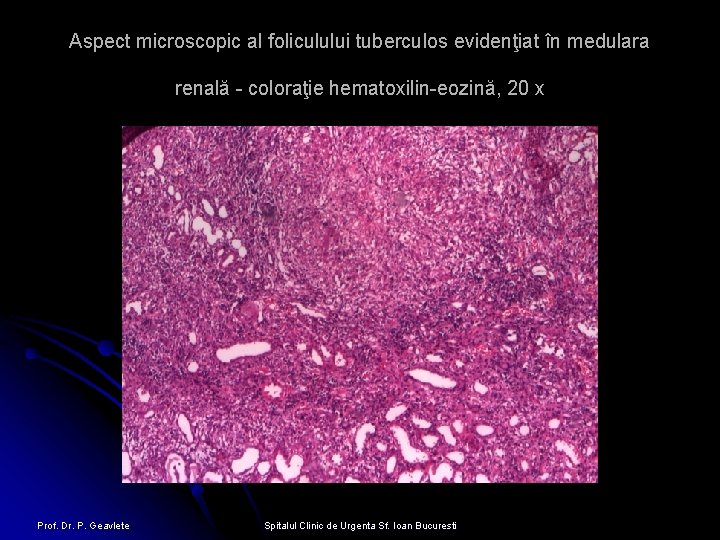 Aspect microscopic al foliculului tuberculos evidenţiat în medulara renală - coloraţie hematoxilin-eozină, 20 x