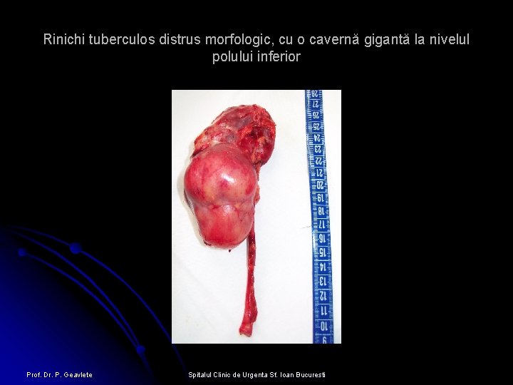 Rinichi tuberculos distrus morfologic, cu o cavernă gigantă la nivelul polului inferior Prof. Dr.