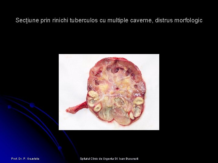 Secţiune prin rinichi tuberculos cu multiple caverne, distrus morfologic Prof. Dr. P. Geavlete Spitalul