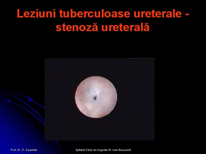 Leziuni tuberculoase ureterale stenoză ureterală Prof. Dr. P. Geavlete Spitalul Clinic de Urgenta Sf.