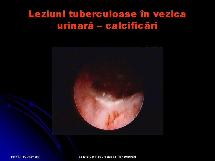 Leziuni tuberculoase în vezica urinară – calcificări Prof. Dr. P. Geavlete Spitalul Clinic de