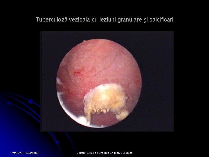 Tuberculoză vezicală cu leziuni granulare şi calcificări Prof. Dr. P. Geavlete Spitalul Clinic de