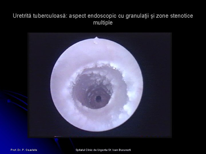 Uretrită tuberculoasă: aspect endoscopic cu granulaţii şi zone stenotice multiple Prof. Dr. P. Geavlete