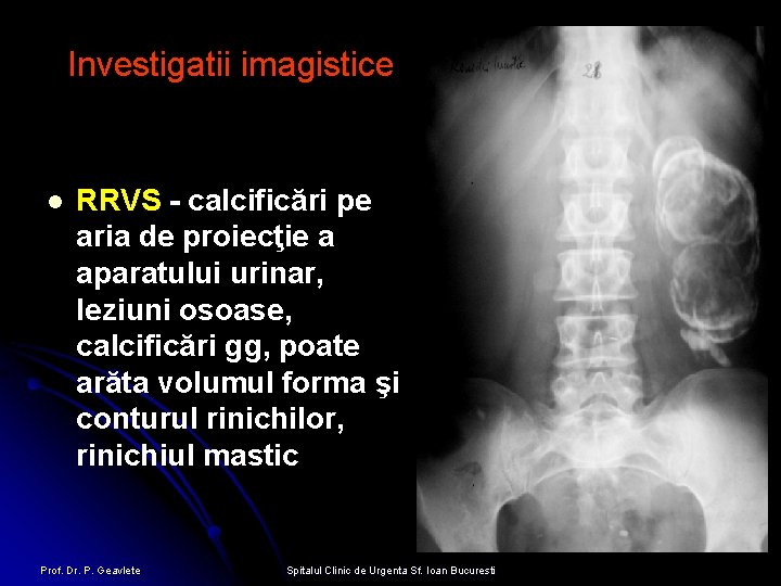 Investigatii imagistice l RRVS - calcificări pe aria de proiecţie a aparatului urinar, leziuni