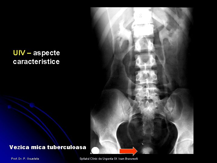 UIV – aspecte caracteristice Vezica mica tuberculoasa Prof. Dr. P. Geavlete Spitalul Clinic de